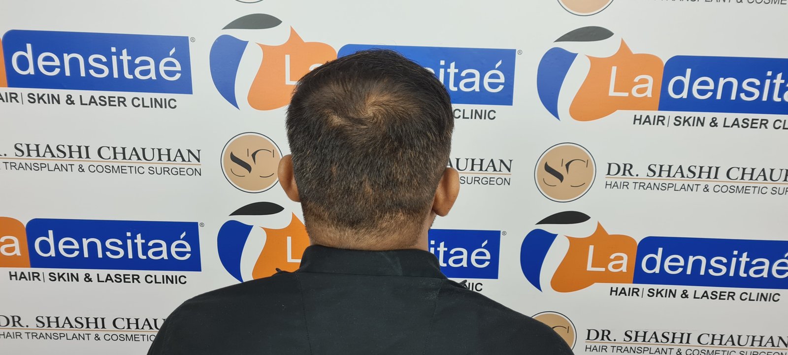 Abhay Pratap Yadav After Hair Transplant
